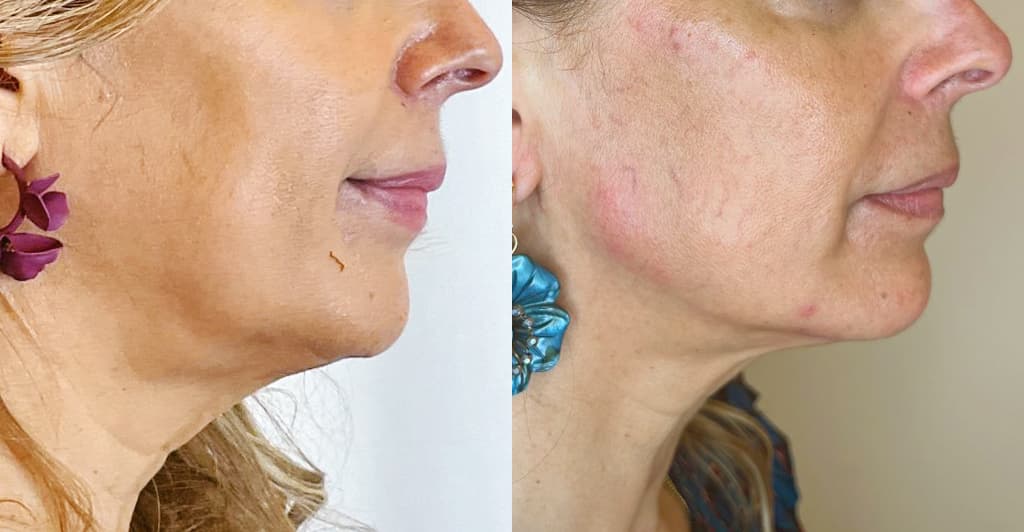 Harmonização Facial